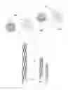 Fig. 03 - Retrievable covered stent for bifurcation aneurysms
