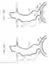 Fig. 09 - Endovascular flow direction indicator