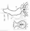 Fig. 10 - Endovascular flow direction indicator