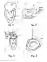 Fig. 02 - Device and method for reducing cardiac valve regurgitation