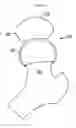 Fig. 05 - RESILIENT MEDICALLY INFLATABLE INTERPOSITIONAL ARTHROPLASTY DEVICE