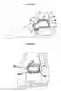 Fig. 12 - RESILIENT MEDICALLY INFLATABLE INTERPOSITIONAL ARTHROPLASTY DEVICE