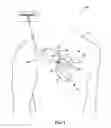 Fig. 02 - IMPLANTABLE MEDICAL DEVICE ELECTRODE ASSEMBLY