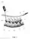 Fig. 02 - Methods, tools and devices for spinal fixation