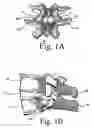 Fig. 02 - INSERTION OF ARTIFICIAL/PROSTHETIC FACET JOINTS WITH BALLOTABLE/COMPRESSIBLE JOINT SPACE COMPONENT