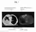 Fig. 02 - METHOD OF RADIOTHERAPY USING A RADIOLABELLED RGD PEPTIDE