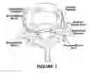 Fig. 02 - Injection of fibrin sealant using reconstituted components in spinal applications