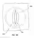 Fig. 50 - Wound retractor with gel cap