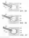 Fig. 08 - Subcutaneous cavity marking device