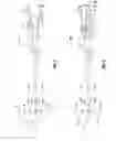 Fig. 02 - Dialysis catheter assembly