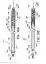 Fig. 10 - Method for open surgical placement