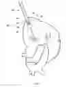 Fig. 06 - TRANSAPICAL CLOSURE DEVICES AND METHODS FOR USE