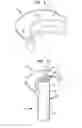 Fig. 02 - Apparatus and method for heart valve repair