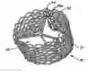 Fig. 01 - Methods and Apparatus for Endovascularly Replacing a Patient's Heart Valve