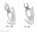 Fig. 22 - Methods and Apparatus for Endovascularly Replacing a Patient's Heart Valve