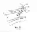 Fig. 10 - TRACHEAL STOMA DILATION APPARATUS AND METHOD OF MANUFACTURE