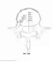 Fig. 49 - Methods of therapeutically heating a vertebral body to treat back pain