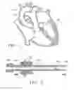 Fig. 02 - Apparatus and Methods for Anastomosis