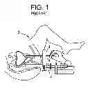 Fig. 02 - Brachytherapy template adaptor