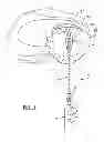 Fig. 07 - Device for repairing a meniscal tear
