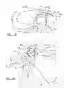 Fig. 15 - Device for repairing a meniscal tear