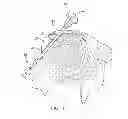 Fig. 16 - Device for repairing a meniscal tear