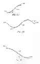 Fig. 06 - ENDOLUMINAL FILTER WITH FIXATION