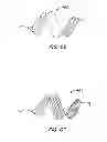 Fig. 33 - ENDOLUMINAL FILTER WITH FIXATION