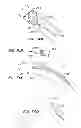 Fig. 40 - ENDOLUMINAL FILTER WITH FIXATION