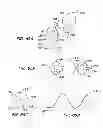 Fig. 49 - ENDOLUMINAL FILTER WITH FIXATION