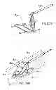 Fig. 69 - ENDOLUMINAL FILTER WITH FIXATION