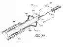 Fig. 13 - IMPLANT RETRIEVAL SYSTEM