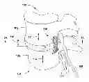 Fig. 01 - APPARATUS FOR COMPRESSING OR DECOMPRESSING A SPINAL DISC AND METHOD OF USE THEREOF
