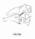 Fig. 131 - Vertebral joint implants and delivery tools