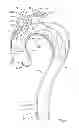 Fig. 06 - Thoracic stent graft