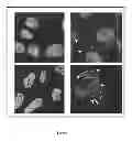 Fig. 20 - Breast Tumor Markers and Methods of Use Thereof
