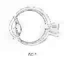 Fig. 02 - Ocular implant with therapeutic agent and methods thereof