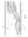 Fig. 12 - Focal Ablation Assembly