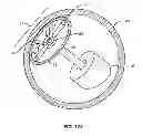 Fig. 13 - Focal Ablation Assembly