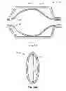 Fig. 14 - Focal Ablation Assembly