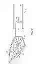 Fig. 16 - Focal Ablation Assembly