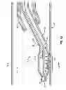 Fig. 12 - Focal ablation assembly