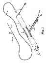Fig. 02 - Rotational atherectomy device with electric motor