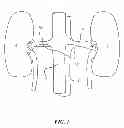 Fig. 02 - Image-guided renal nerve ablation