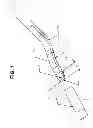 Fig. 02 - Corneal implant retaining devices and methods of use