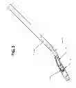 Fig. 03 - Corneal implant retaining devices and methods of use
