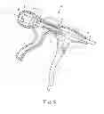 Fig. 04 - Suture system with capsule eyelet providing multiple suture tissue fixation