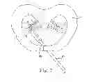 Fig. 19 - Suture system with capsule eyelet providing multiple suture tissue fixation