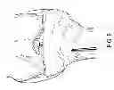 Fig. 08 - Suture tensioning device