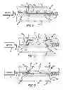Fig. 02 - Apparatus and method for deployment of a therapeutic device using a catheter